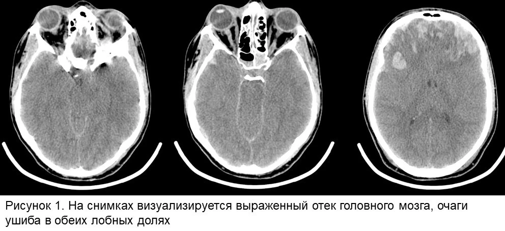 🧠 Современные возможности нейрохирургии и нейрореанимации позволяют не только спасать ранее практиче