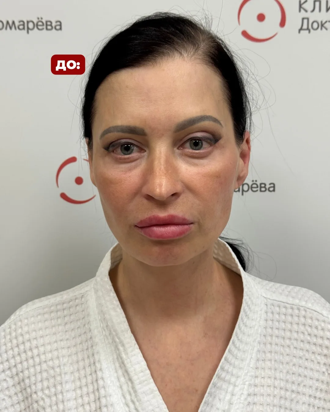 На фото результат всего через 1 месяц после комплексного омоложения лица: ✔ эндоскопическая подтяжка