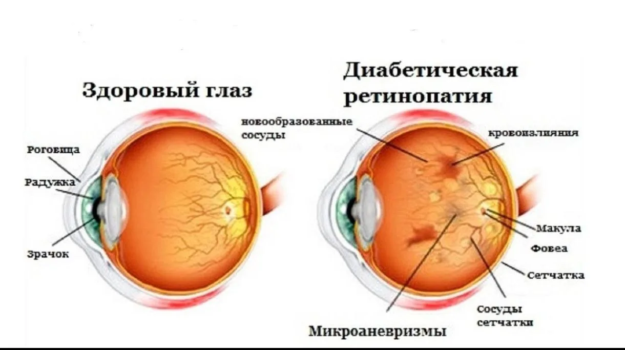 Школа диабета