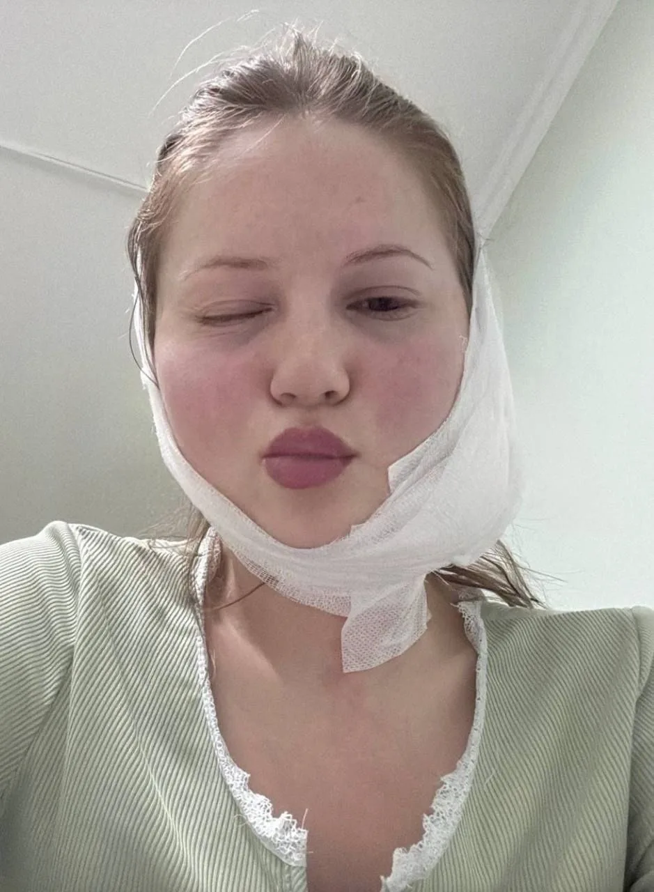 🦷🥼Во Владивостоке девушка хотела удалить зуб мудрости, а получила перекошенное лицо и опасную гнойну