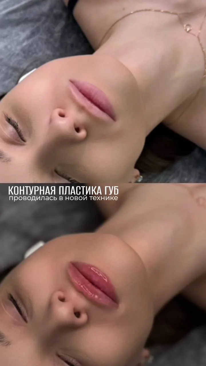 Делимся прекрасными до/после контурной пластики губ 👄💉