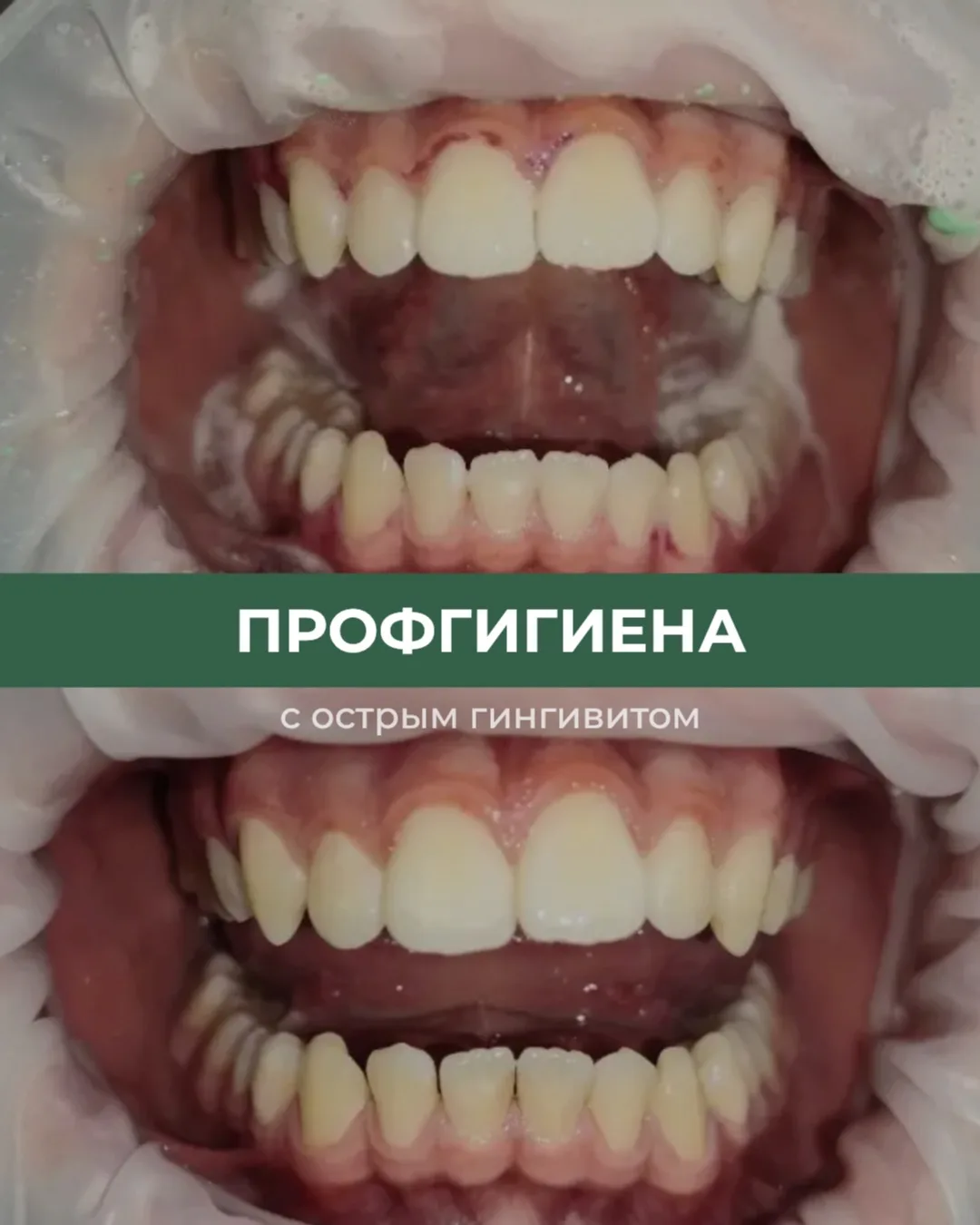 Профгигиена у 15-летнего пациента с острым гингивитом📍