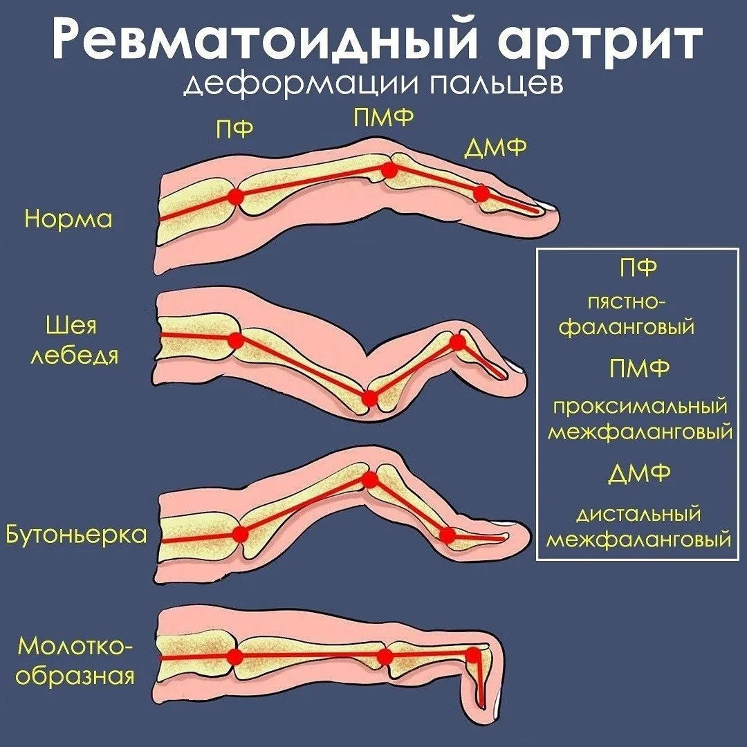 Ревматоидный артрит