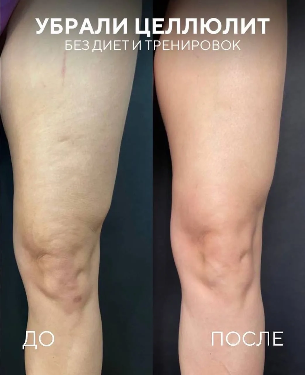 Убрали целлюлит без диет и тренировок 👌🏼

К нам в клинику обратилась пациентка, которую беспокоил 