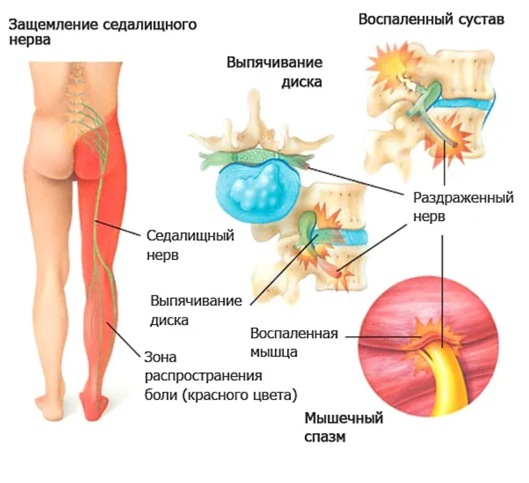 🌿 ЗАЩЕМЛЕНИЕ СЕДАЛИЩНОГО НЕРВА: КАК СВЯЗАНЫ ВНУТРЕННИЕ ОРГАНЫ И НЕРВНАЯ СИСТЕМА