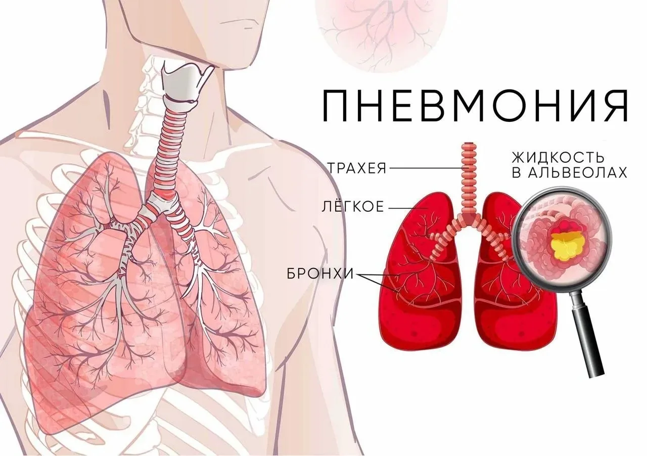 🤒 Распознаем пневмонию вовремя