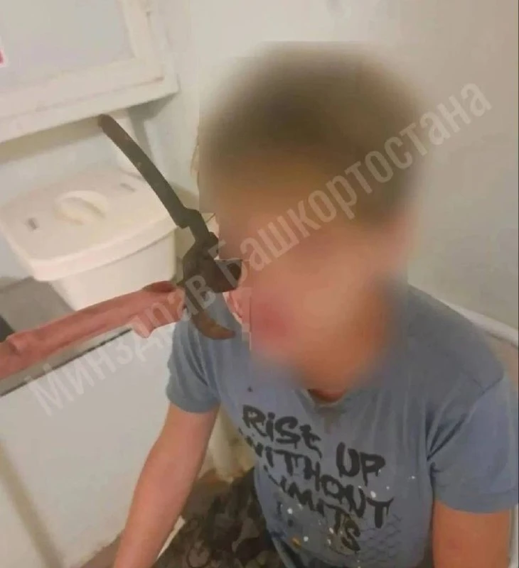 Секатор вонзился в лицо 14-летнему подростку во время игры с братом в Башкирии, — региональный Минзд