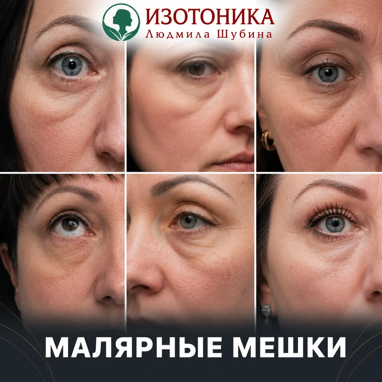 Как появляются малярные мешки под глазами?