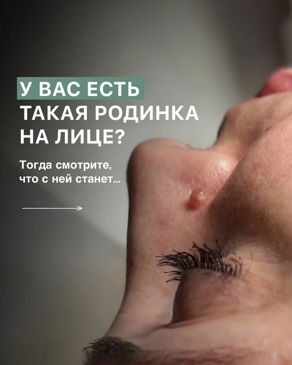 Подробно про удаление на лице рассказала тут ⏏️