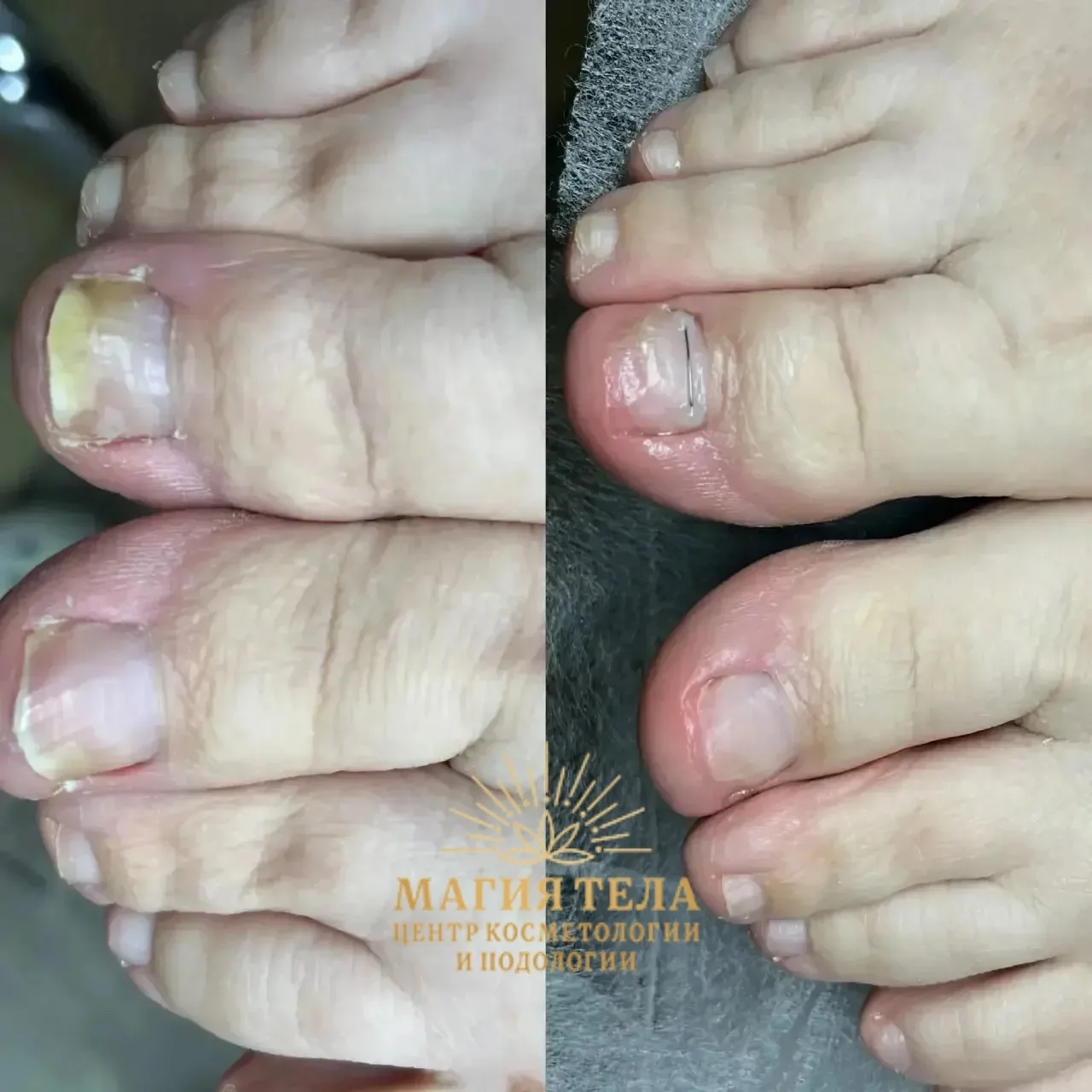 👣 Почему вросший ноготь возвращается снова?