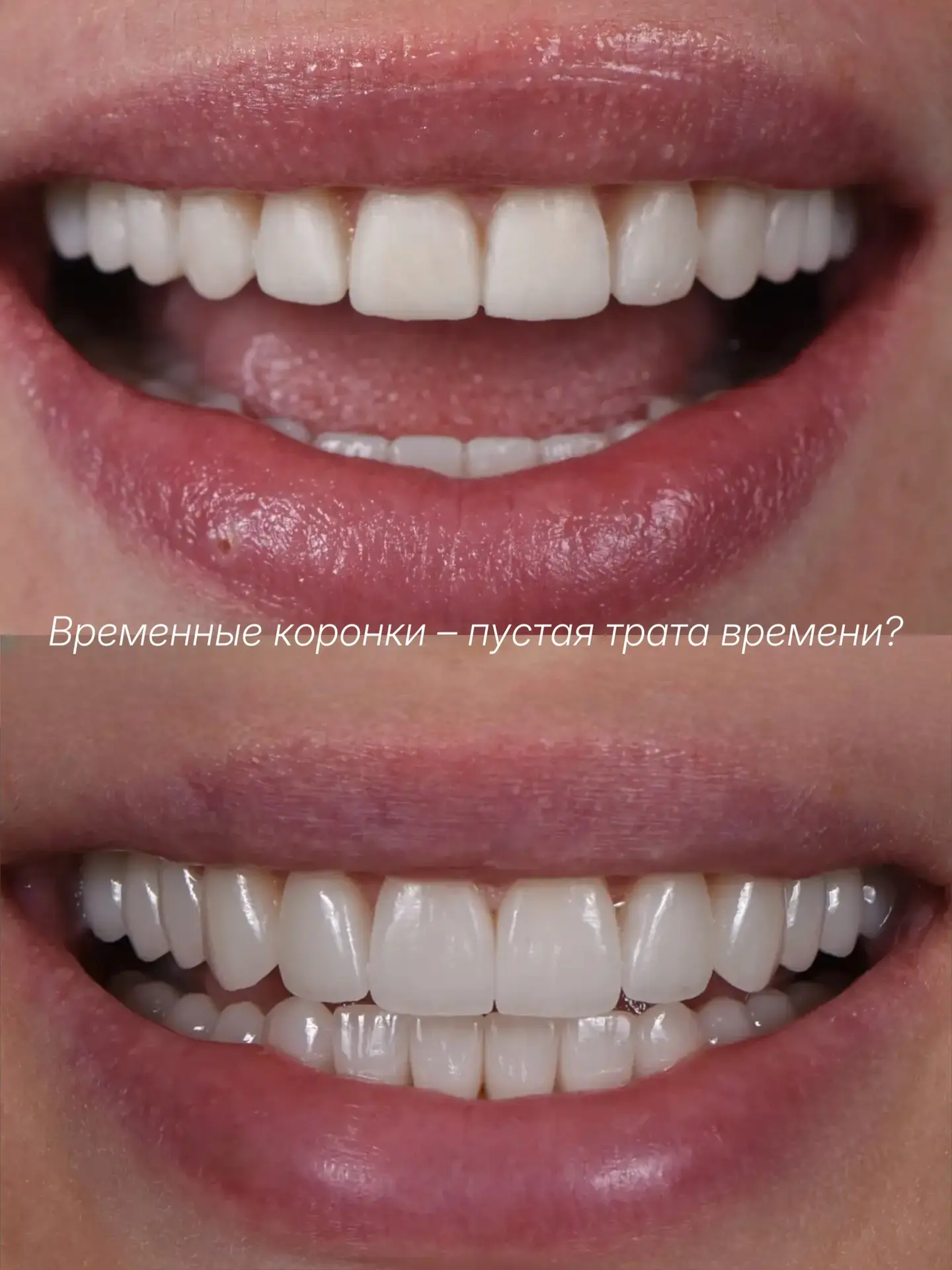 Временные коронки – пустая трата времени и денег?