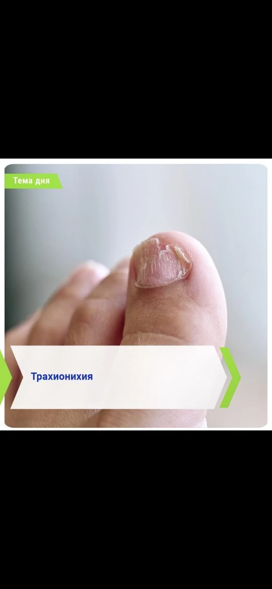 Трахионихия — ногтевая пластина становится рыхлой, тусклой и шероховатой. Иногда ногти ...