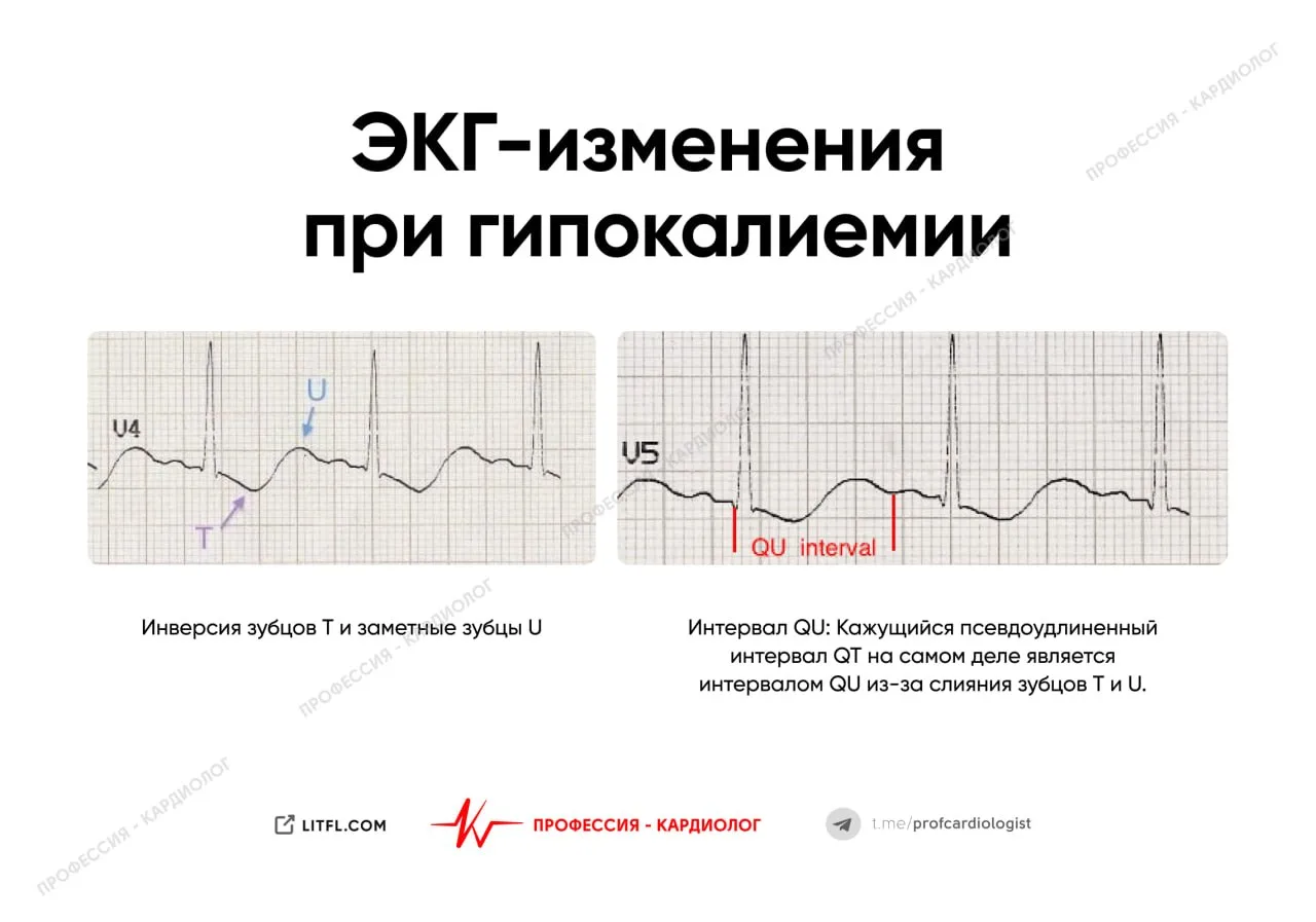 ЭКГ при гипокалиемии

Изменения появляются при уровне K+ < 2,7 ммоль/л:

▪️Увеличение амплитуды и ши