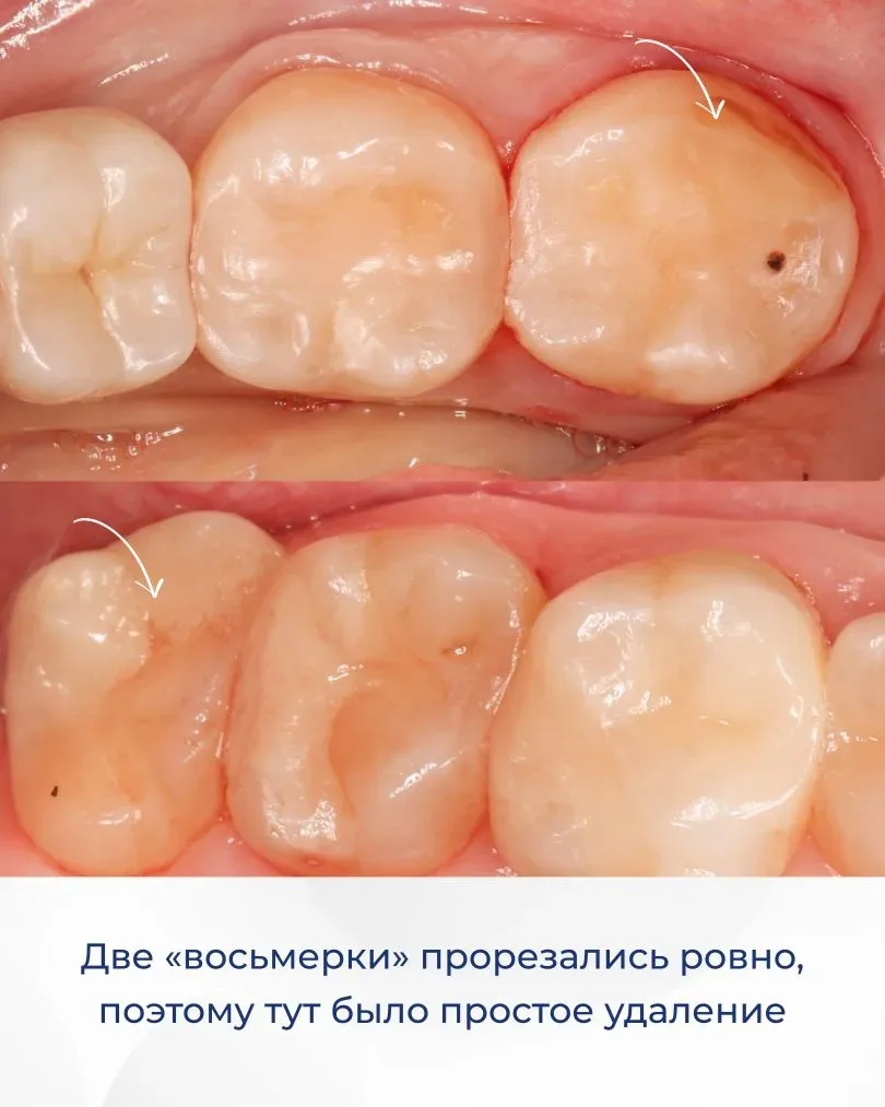 Сразу три зуба удалили пациентке всего за один прием. Это восьмые зубы. Они никак ее не беспокоили и