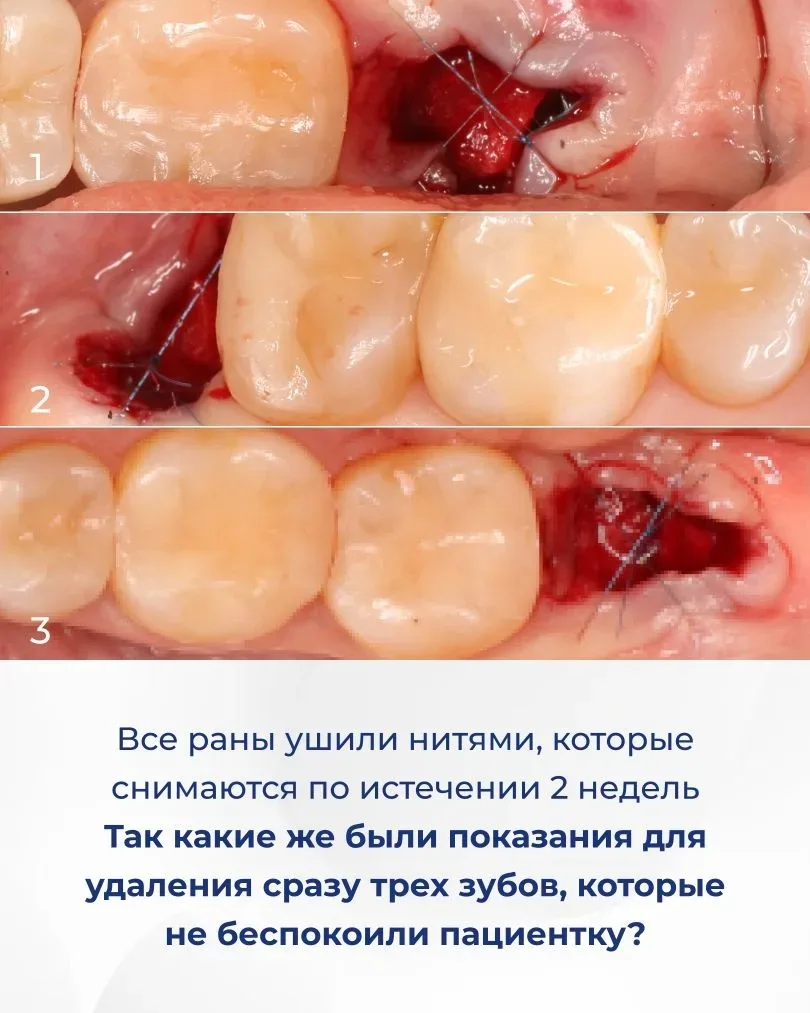 Сразу три зуба удалили пациентке всего за один прием. Это восьмые зубы. Они никак ее не беспокоили и