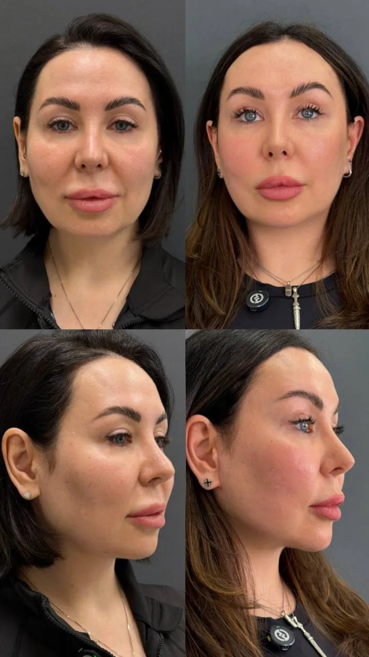 2,5 месяца после TOTAL FACELIFT и результат, который держится годами, а не полгода
