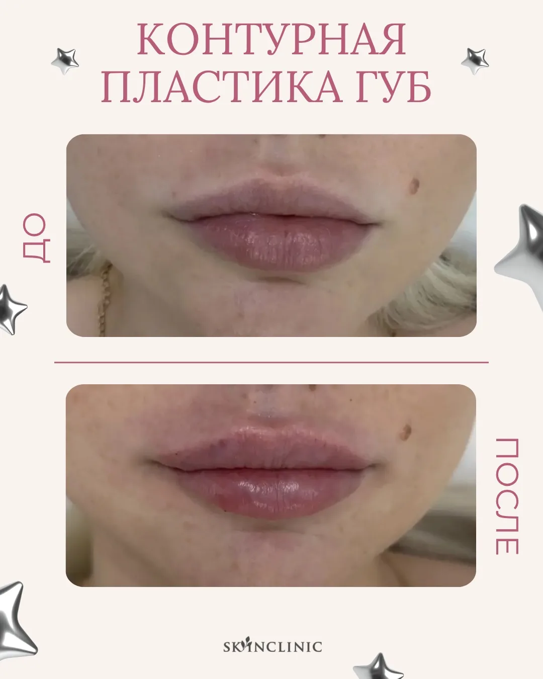 👄Результат после процедуры: контурная пластика губ