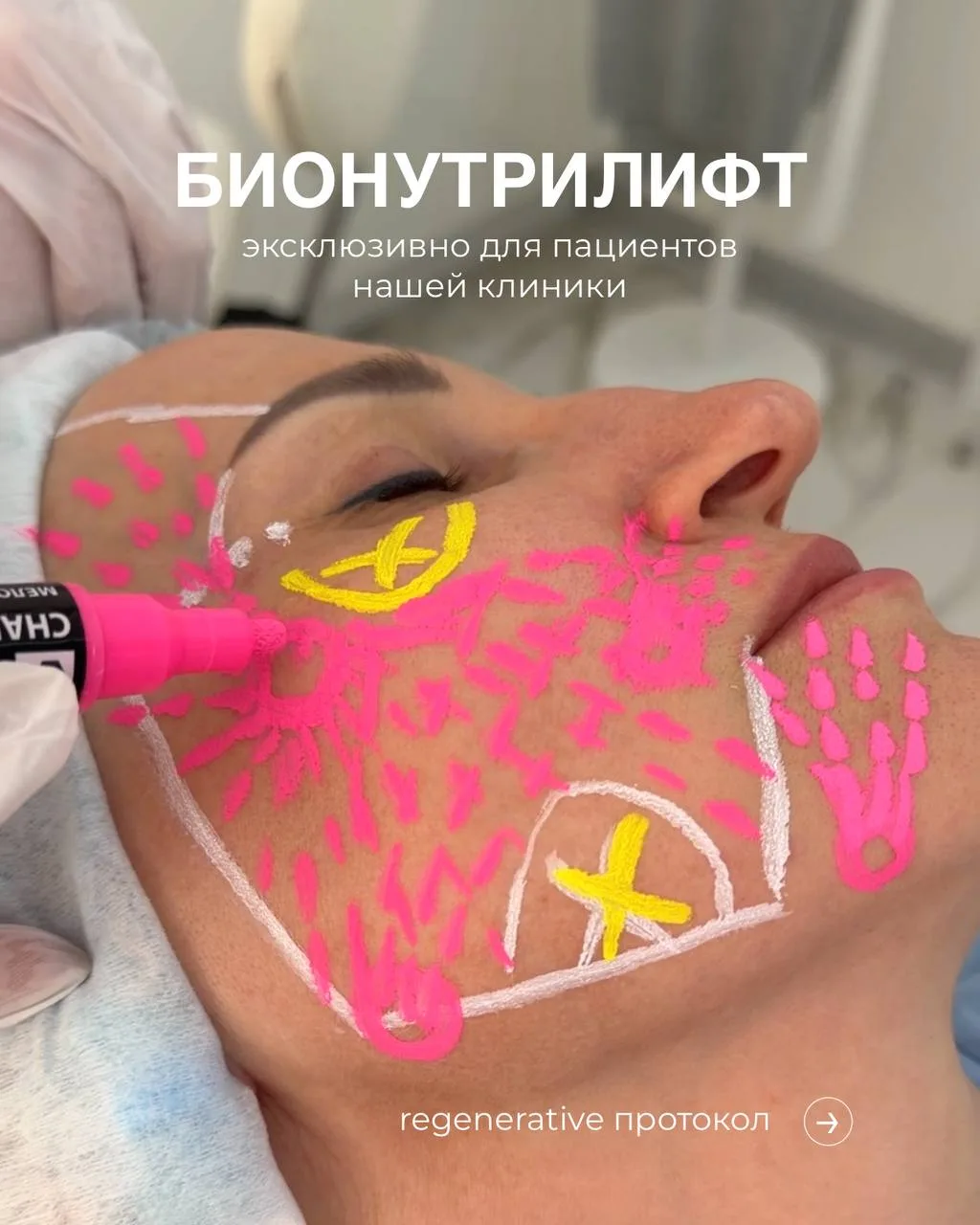 Бионутрилифт