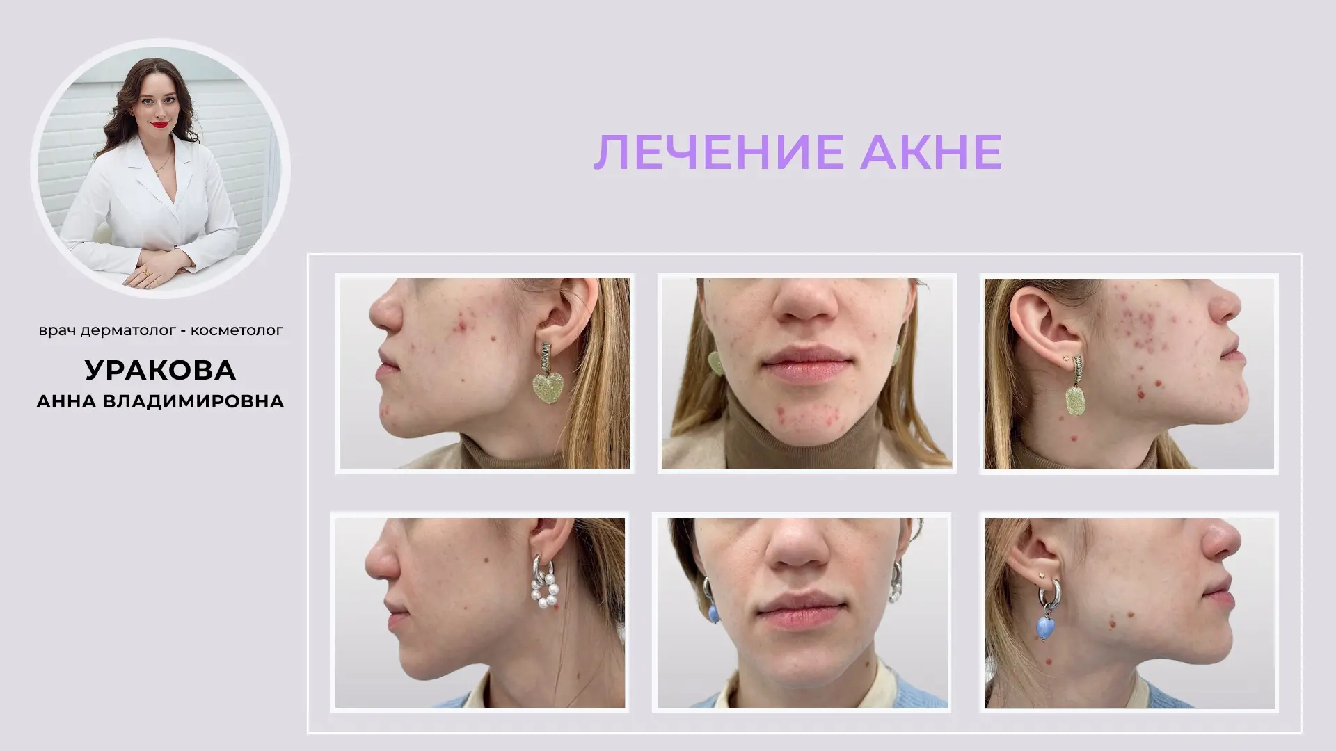 🤫 Что такое акне? Давайте начистоту!

Акне (угревая болезнь, вульгарные угри) — хроническое воспали