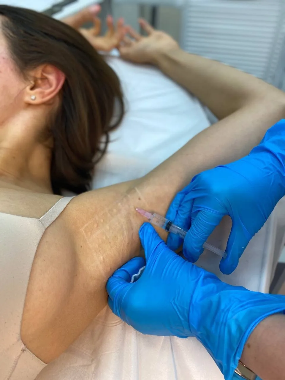 Лечение гипергидроза ботоксом 💉