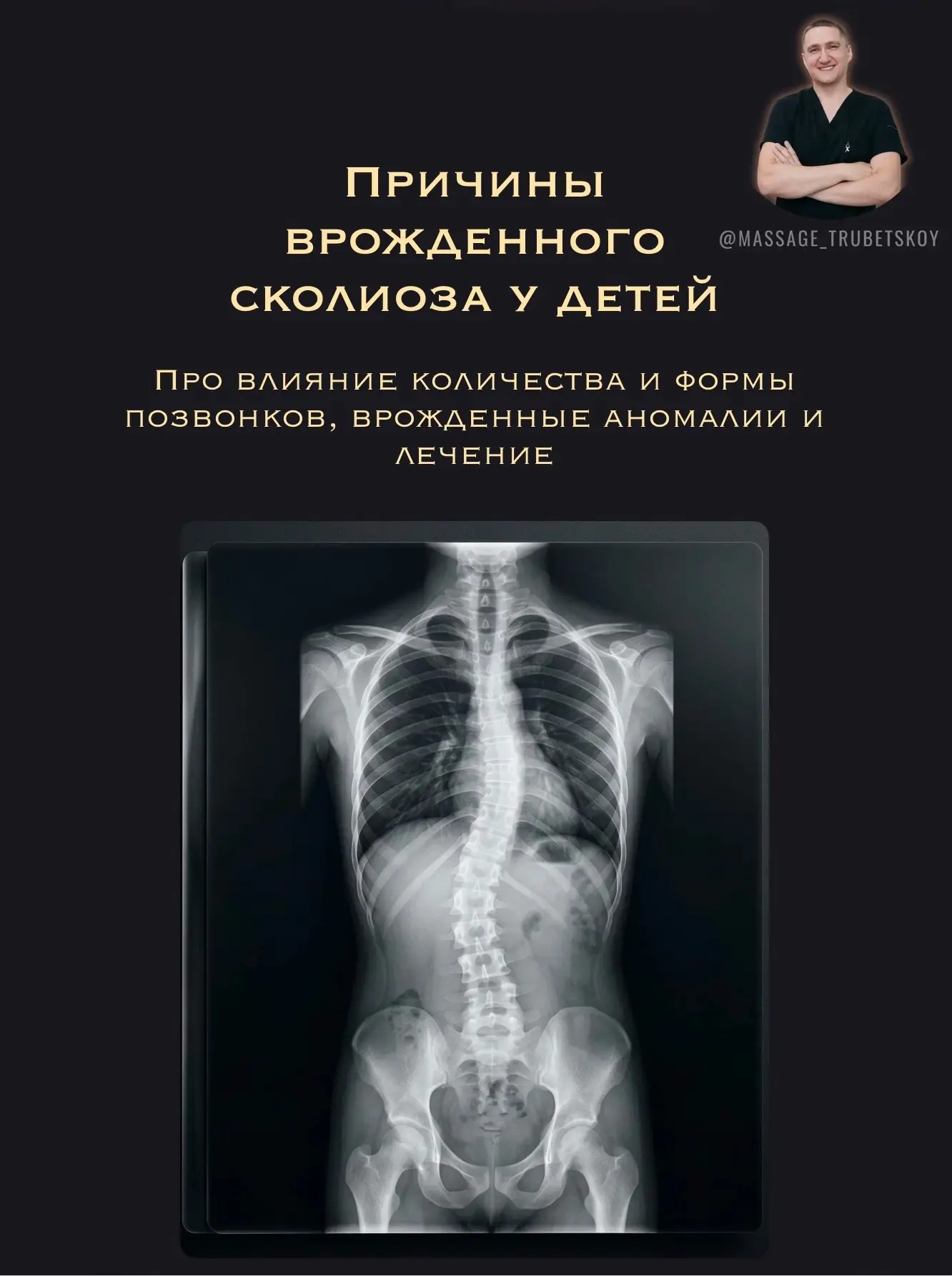 🩻 Причины врожденного сколиоза у детей 🩻