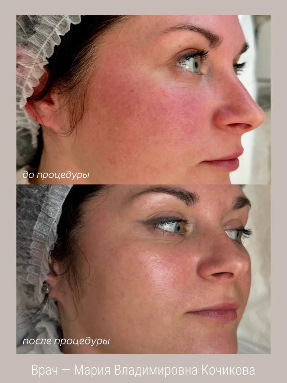 Подготовка к фототерапии напрямую влияет на комфорт процедуры и восстановление кожи пос...