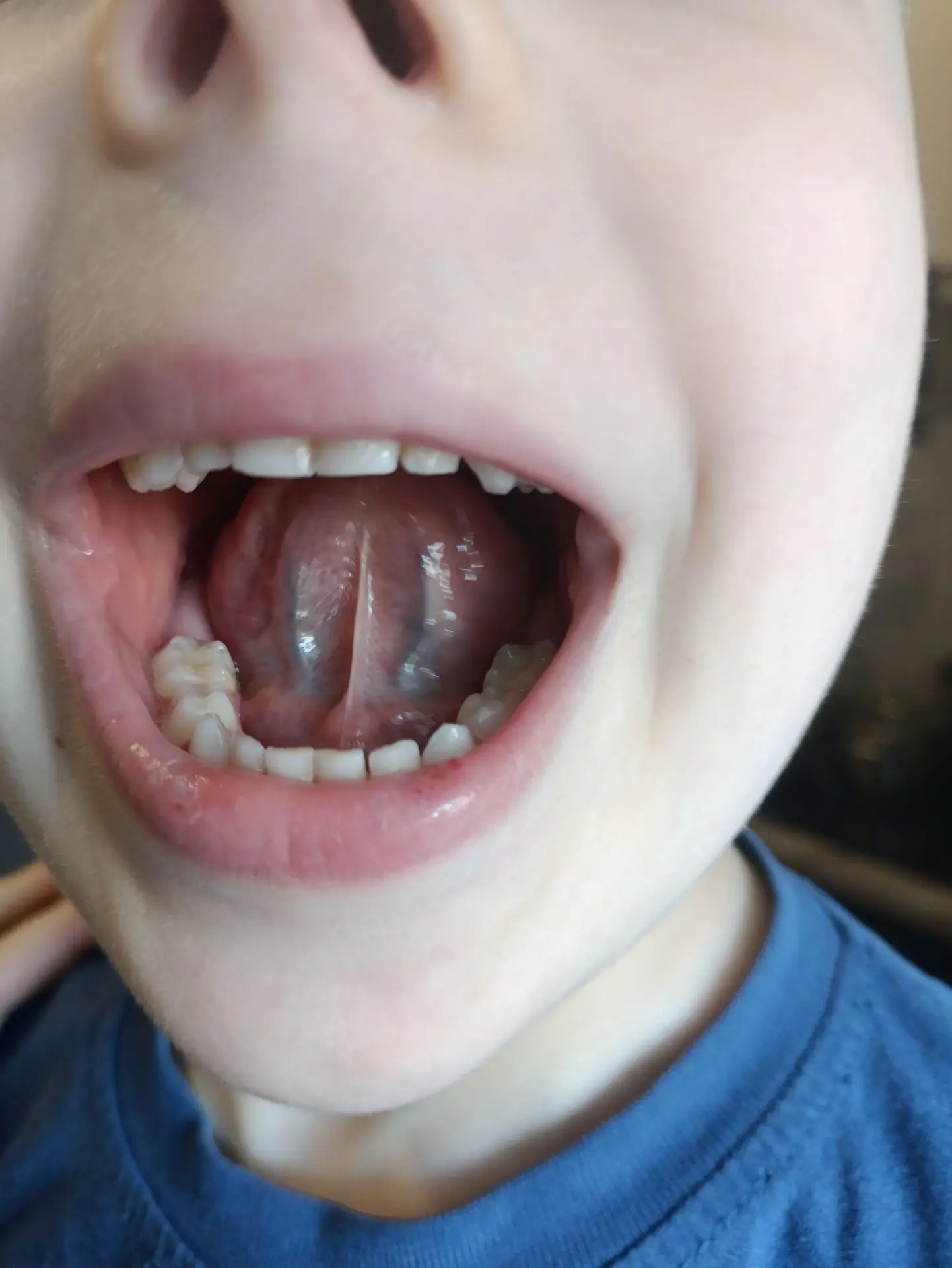 Здравствуйте,4,5 года,до 6 августа практически не болел.6 августа-операция :убрали аден...