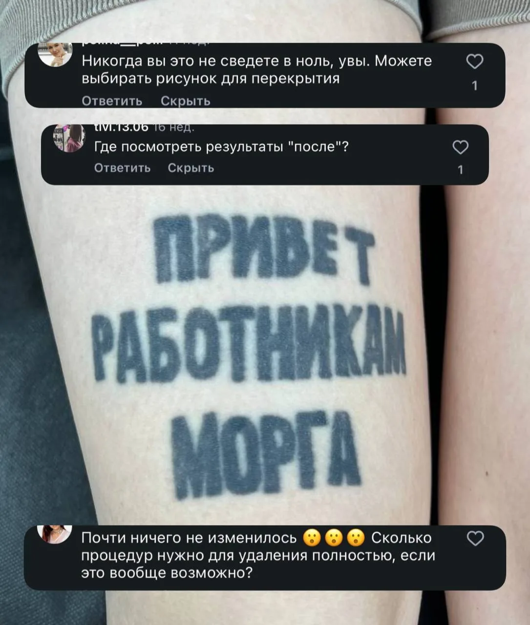 Всем привет! Помните историю моей пациентки с этой скандальной татуировкой?)