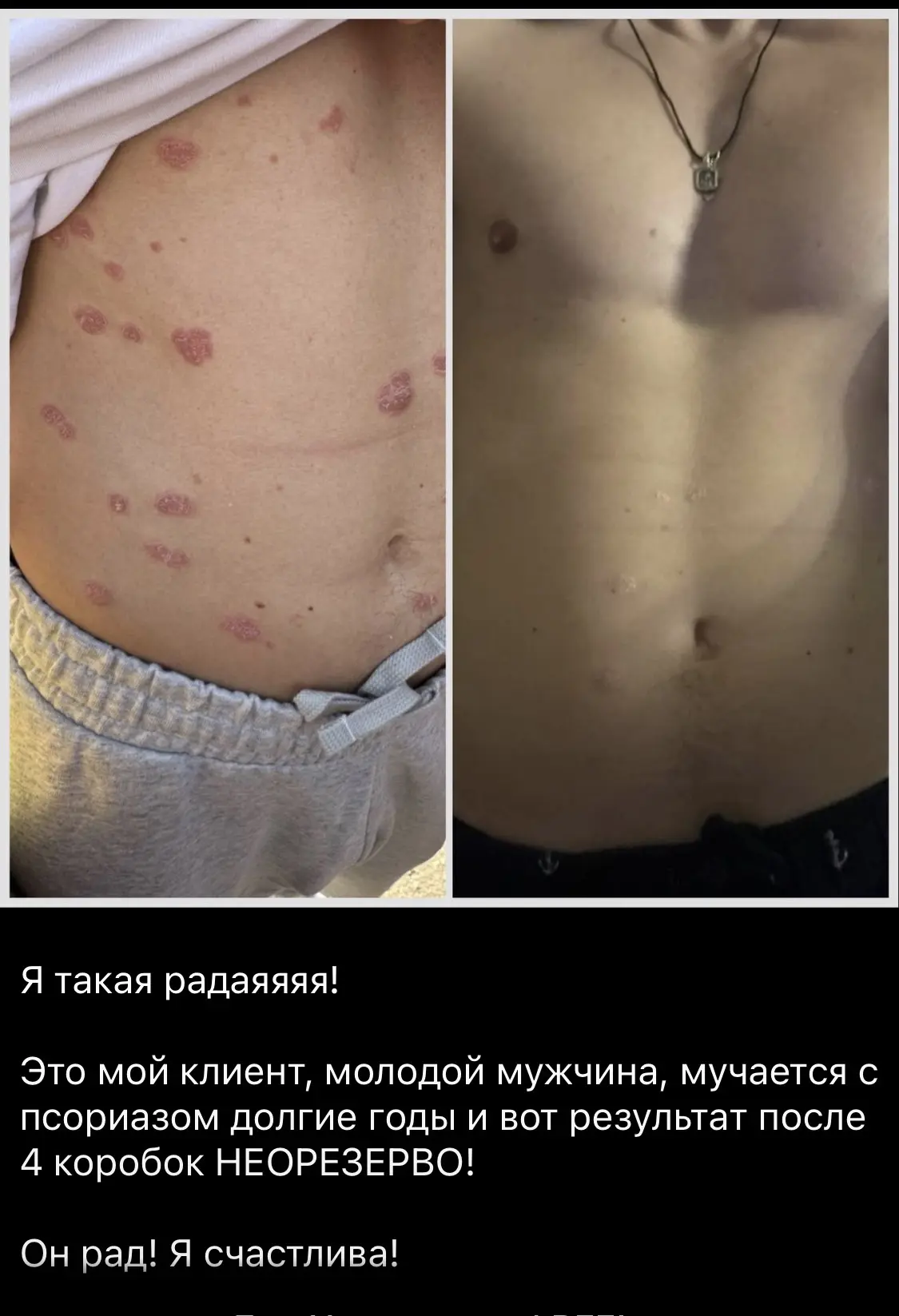 🧬 НЕОРЕЗЕРВО: БОРЬБА С ПСОРИАЗОМ