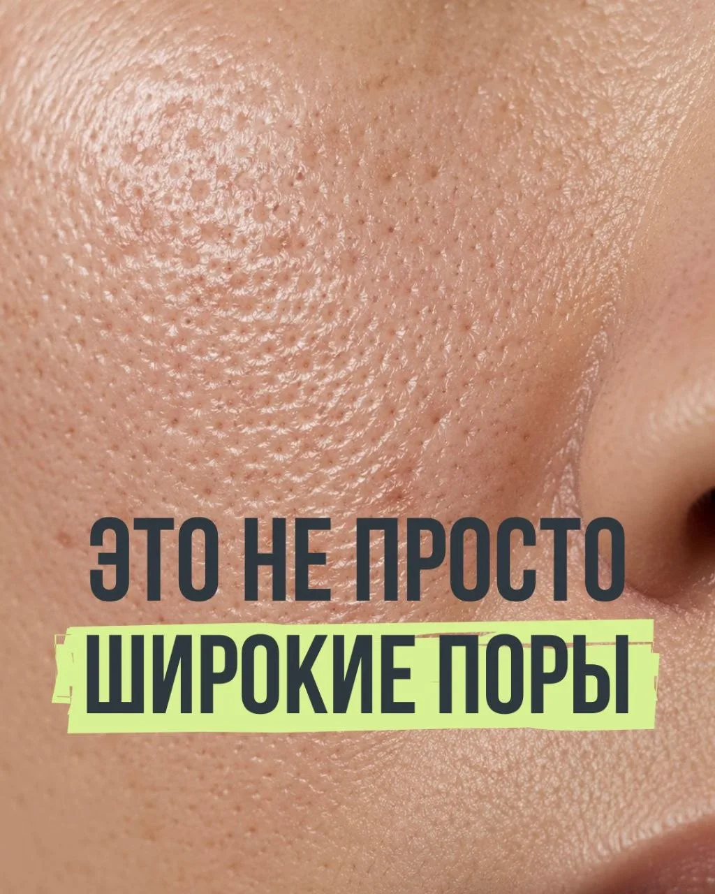 Замечали, что с возрастом поры на щеках стали заметнее и напоминают «апельсиновую корку...