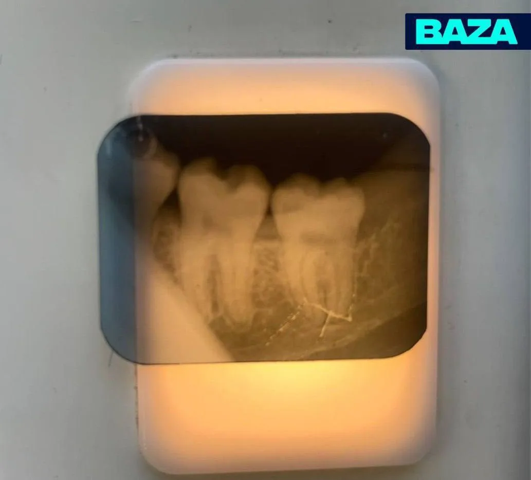 🦷 Москвичка заменила пломбу гелем для ногтей и едва не лишилась зуба

Через два дня боль усилилась 