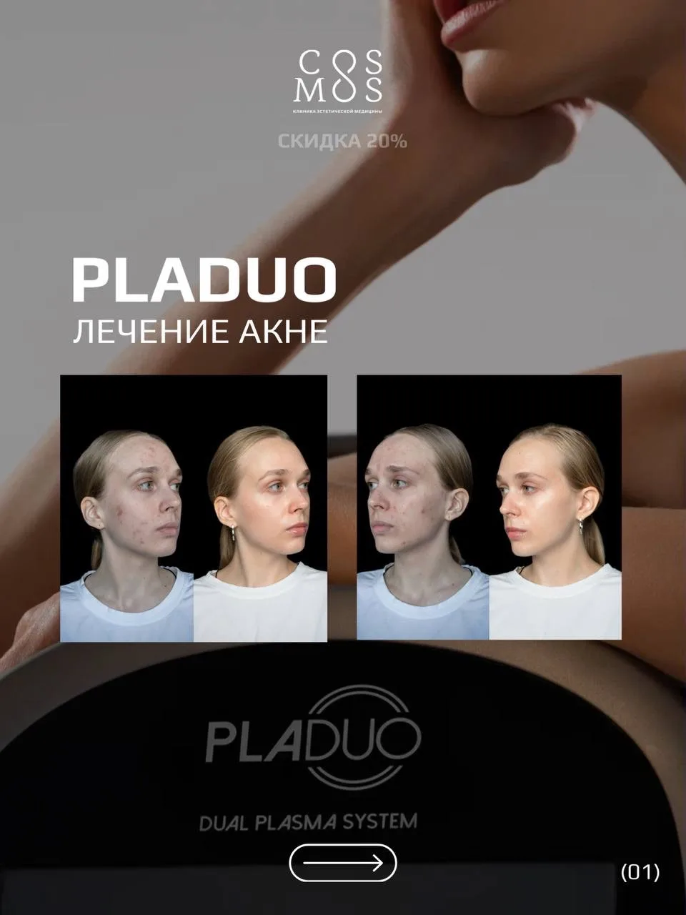 Лечение акне на аппарате