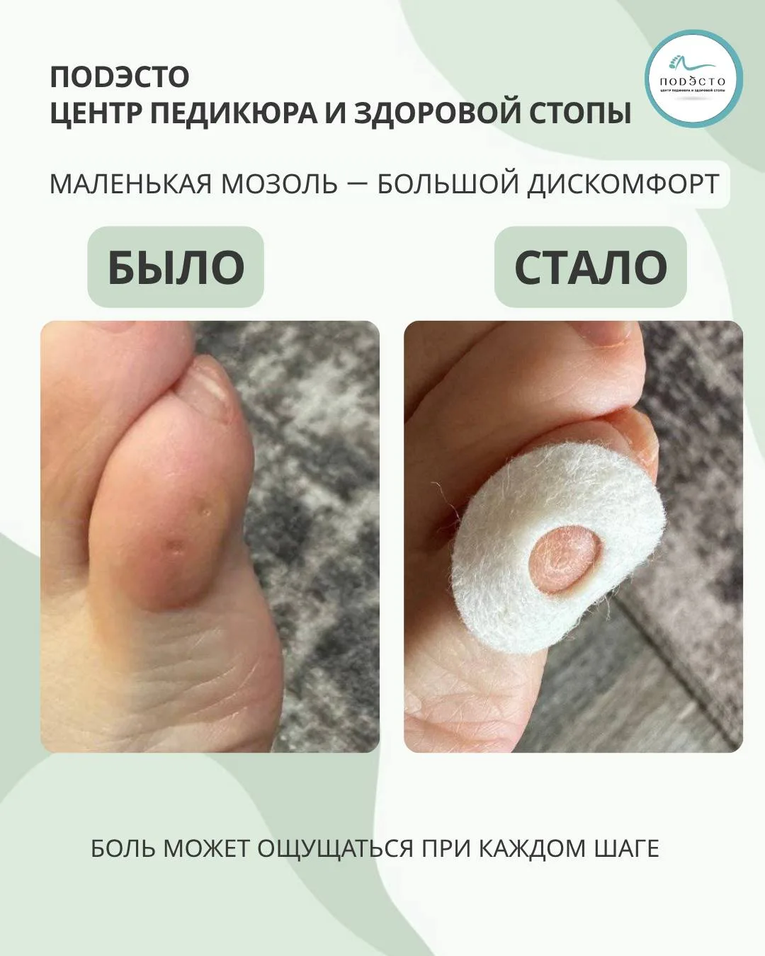 Маленькая мозоль. Большой дискомфорт.  
Иногда проблема размером в несколько миллиметров может мешат
