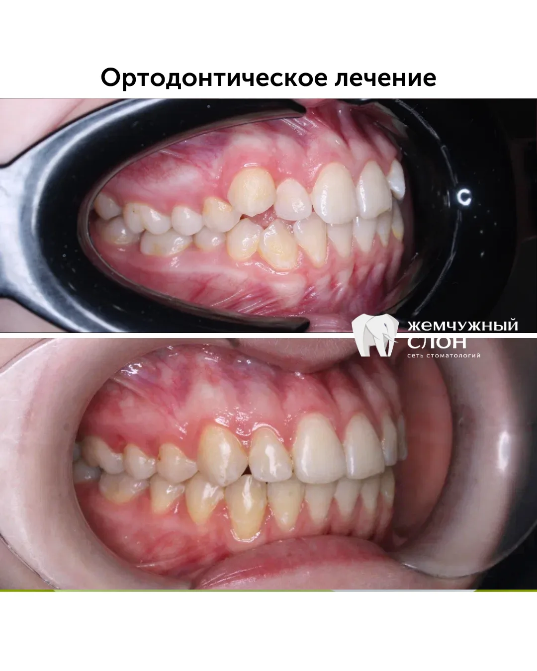 Результат ортодонтического лечения в течение 2 лет на безлигатурных брекетах.