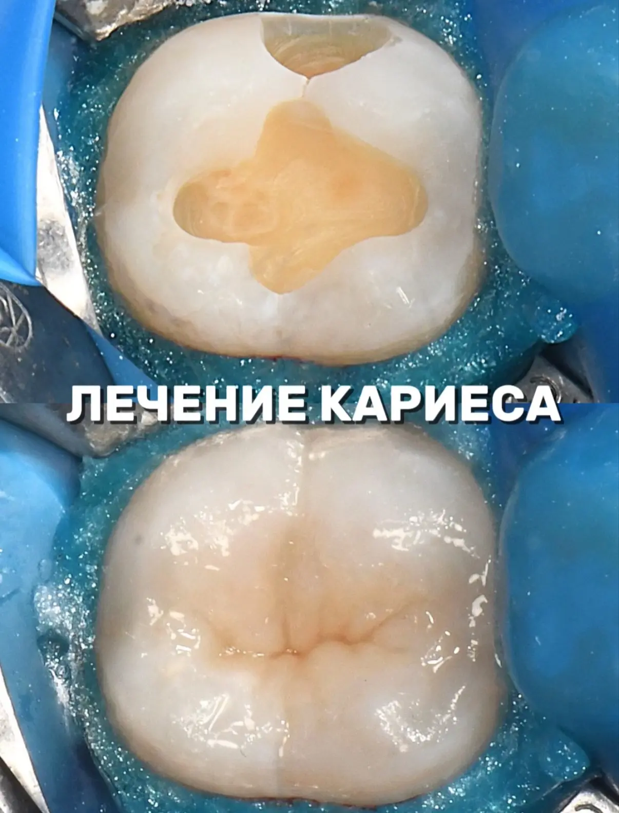 Фото сверху: зуб после препарирования. Дентин открыт — кариес зашёл глубоко, но пульпа цела.
Фото сн
