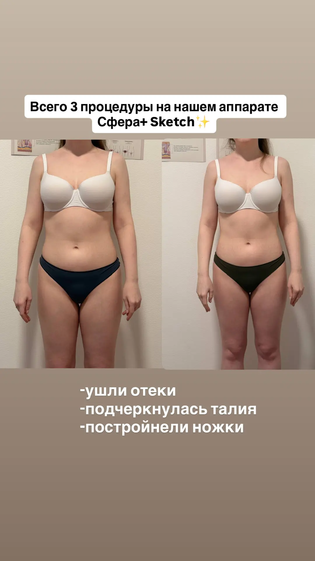 Что происходит во время процедуры на аппарате «Сфера+Sketch»