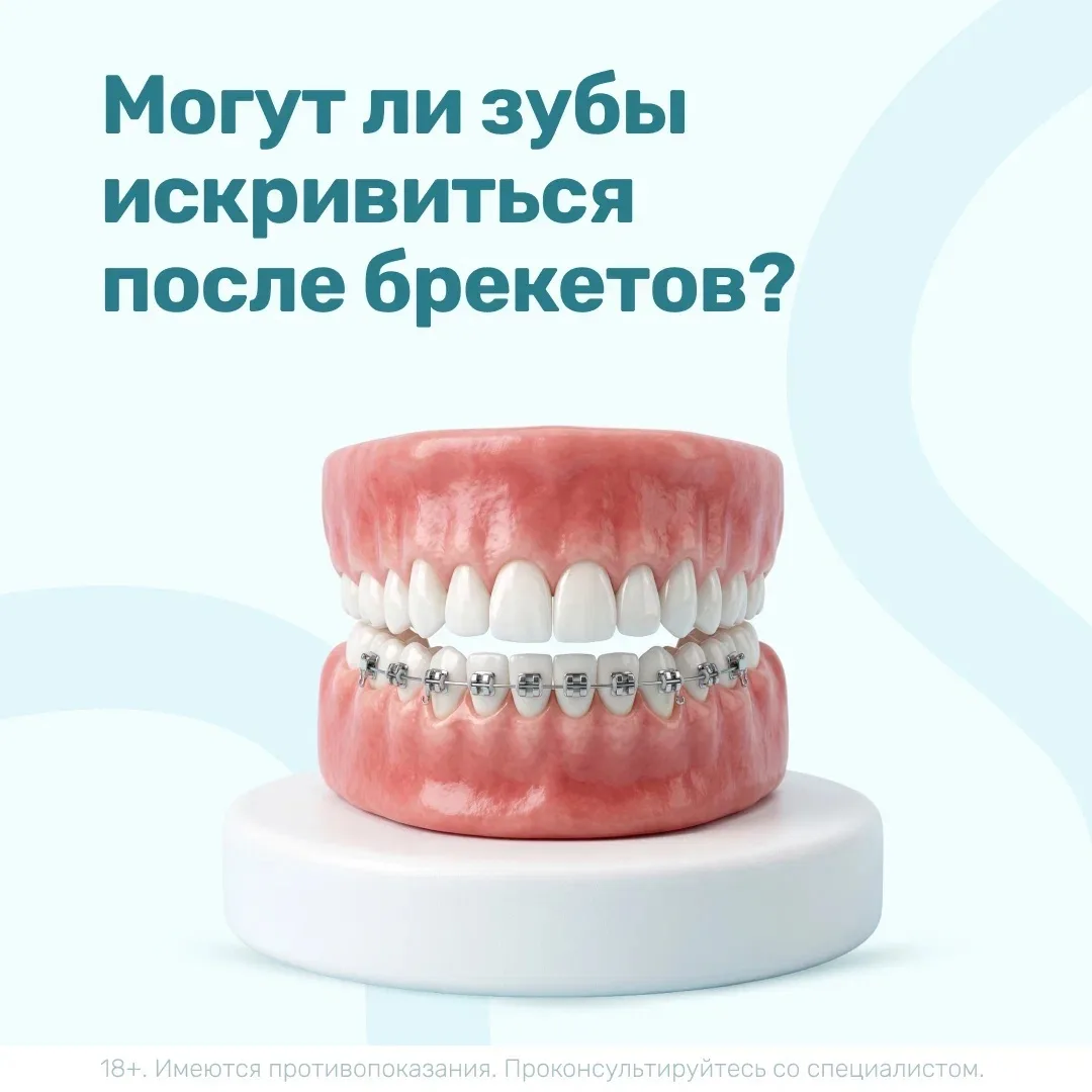 Здравствуйте! Скажите, правда ли, что зубы могут искривиться после брекетов, и как этог...