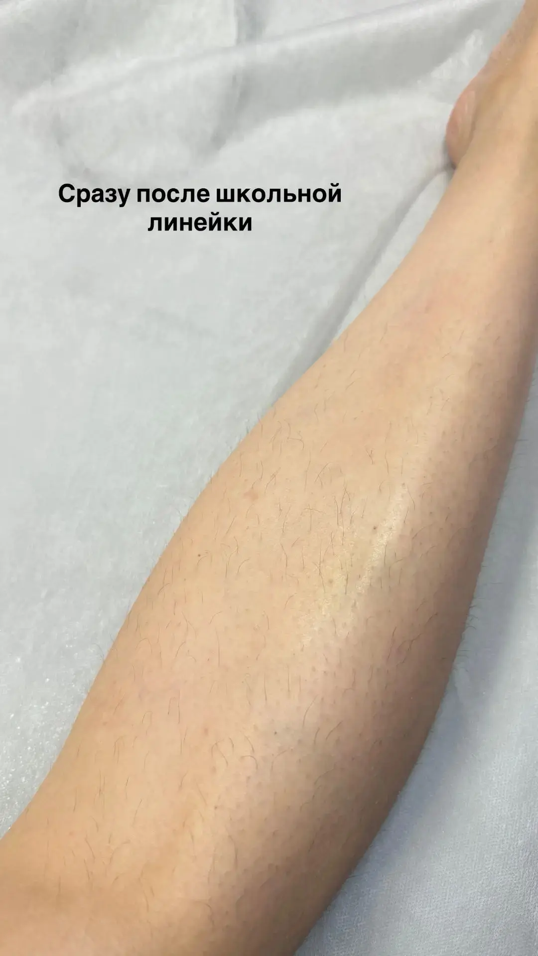 Шугаринг