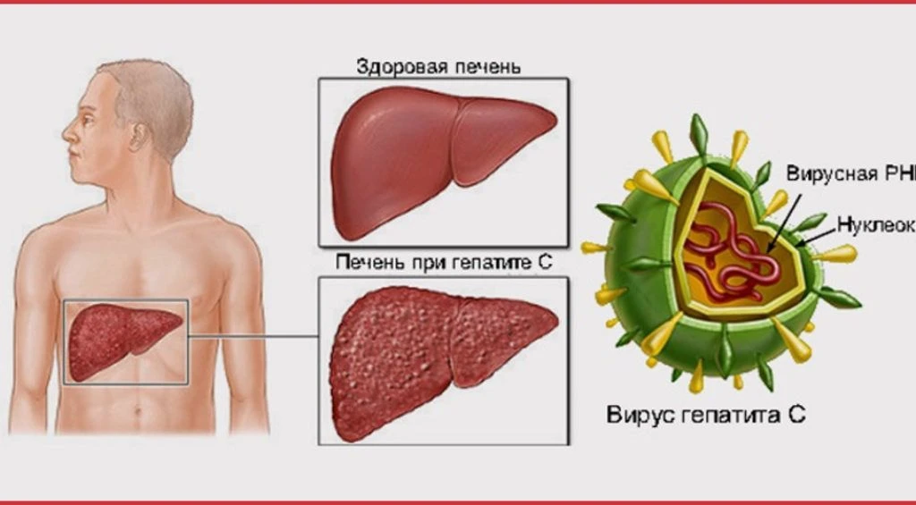 📍Гепатит C — это вирусное поражение печени. Заболевание опасно тем, что часто оно никак себя не про