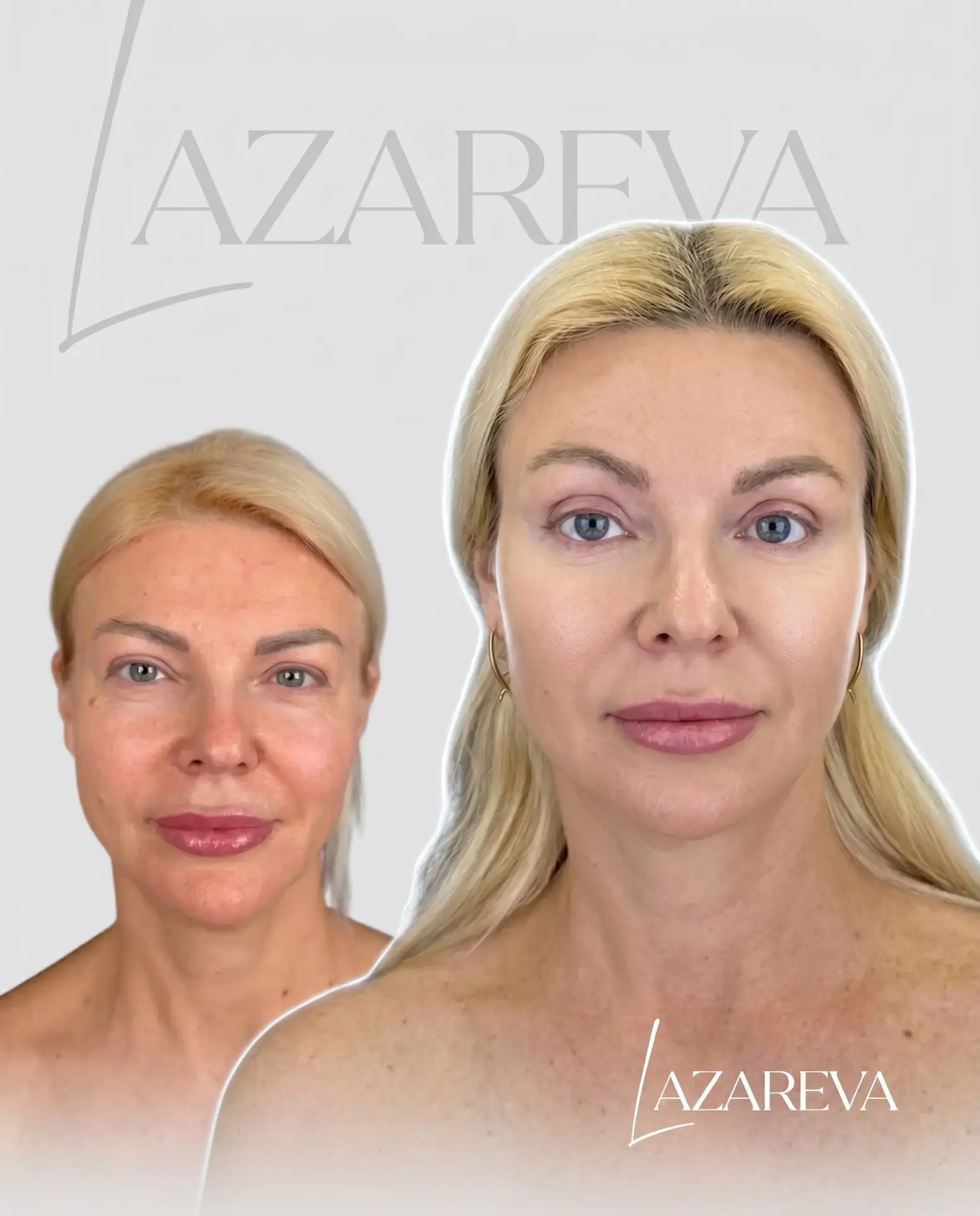 Моя пациентка Наталья🤍