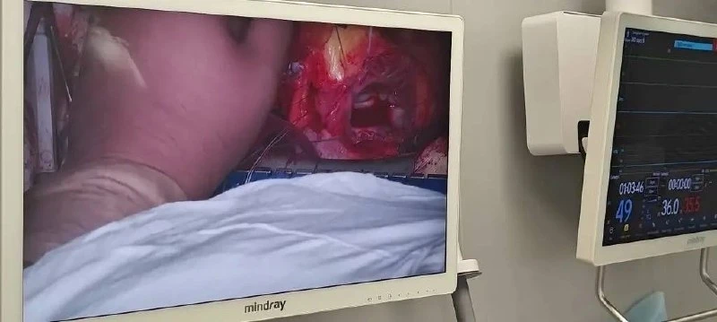 🚑 Две сложные операции за сутки спасли липецкого пациента  В Липецке врачи сделали две серьезные опе