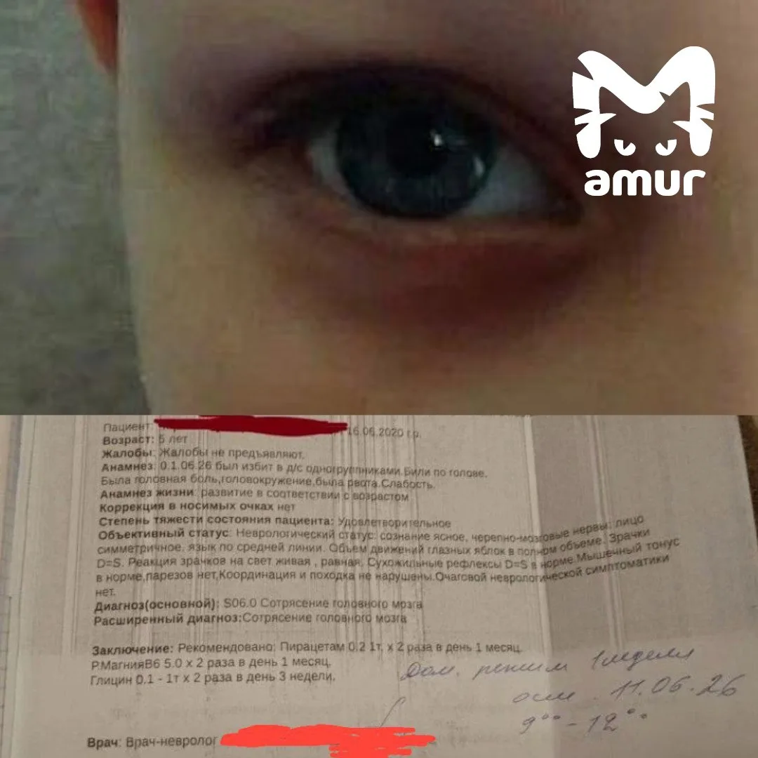 Пятилетний ребёнок получил сотрясение мозга в детсаду Уссурийска.