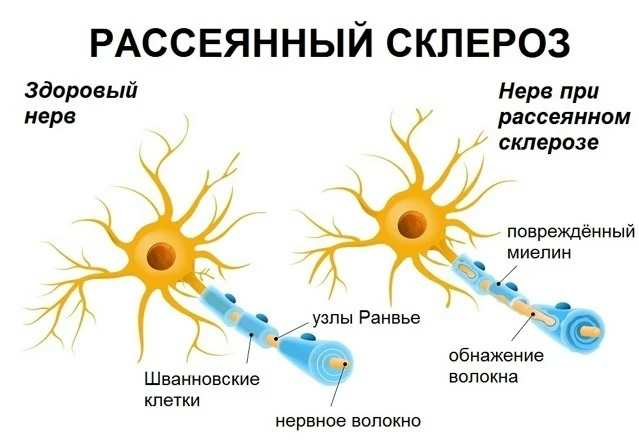 Самые распространенные симптомы рассеянного склероза❗
 
Несмотря на слабую выраженность симптомов, п
