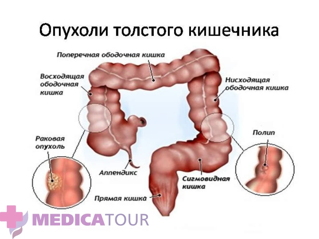 Рак толстой кишки: скрытая угроза, симптомы, факторы риска и меры защиты
👨‍⚕️

Рак толстой кишки (к