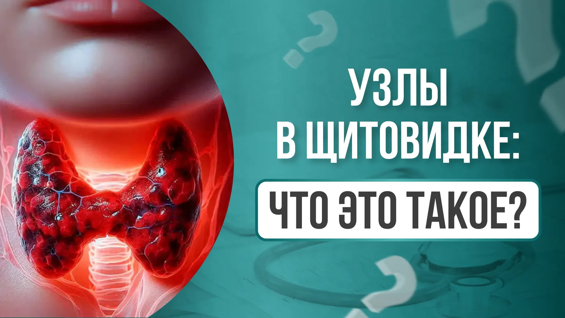 УЗЛЫ В ЩИТОВИДКЕ  Узлы – это образования больше 1 см в диаметре 📋  Всё, что меньше – это фокальные и