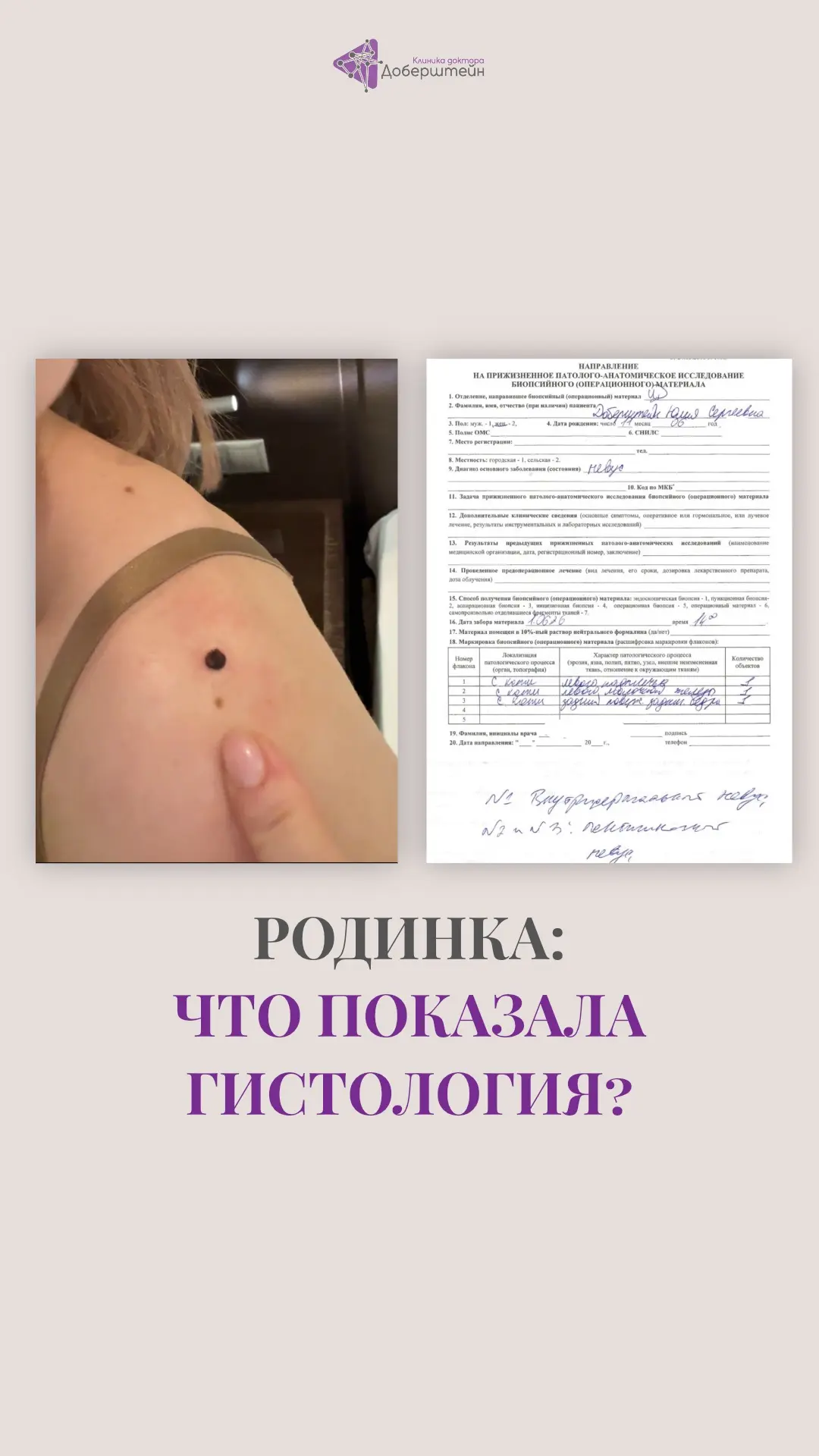 ❗️Три недели назад мы опубликовали видео, в котором Юлия Сергеевна показала родинку, вызвавшую серьё