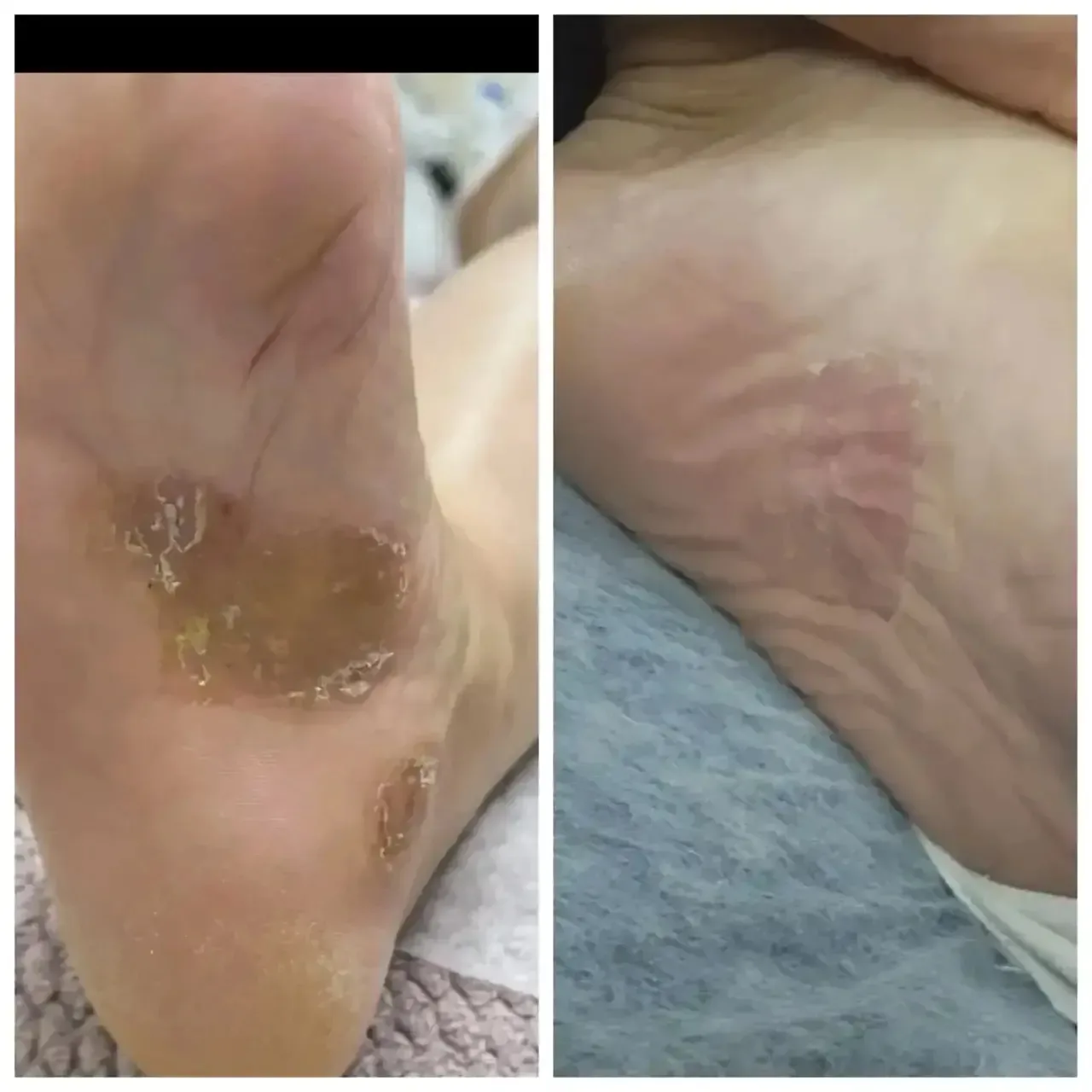 😍 Новая работа, которой хочется поделиться.✨

Лечение ладонно-подошвенного псориаза методами интегр