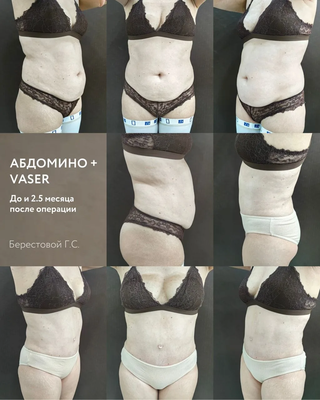 Абдоминопластика + ультразвуковая липосакция Vaser

На фото результат через 2,5 месяца после операци