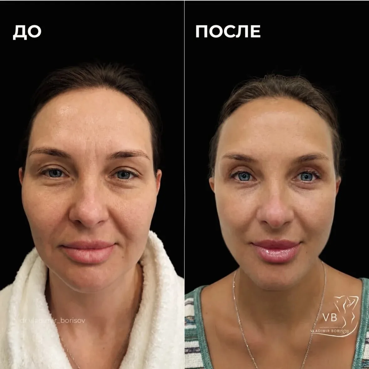 Total face (Тотальное преображение лица)