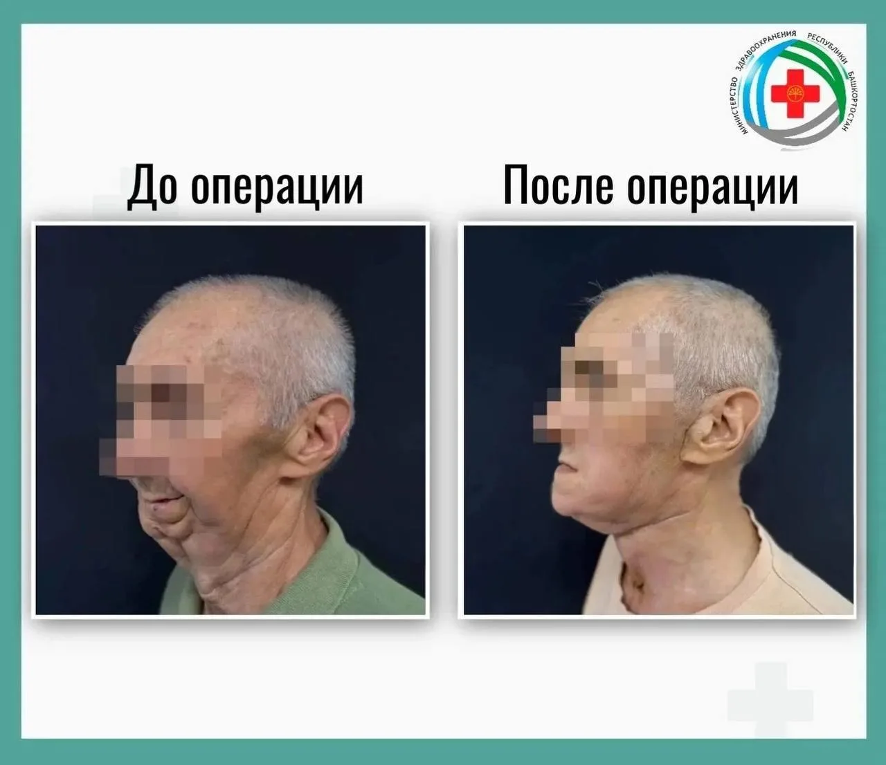 В Башкирии пациенту полностью восстановили челюсть после рака.